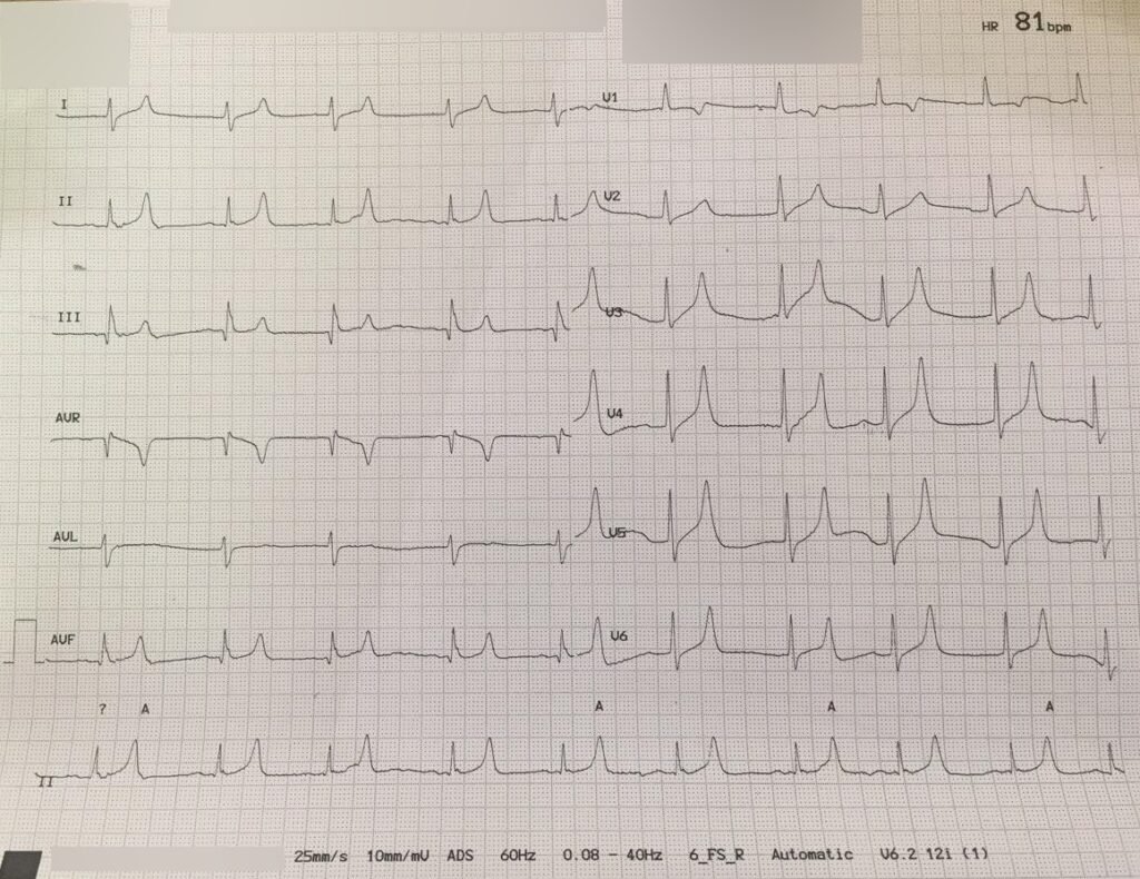 Hyperkalemia_ECG Vector diagram summarizing ECG evolution in hyperkalemia from peaked T waves to sine‑wave.