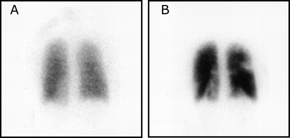 Ventilation–perfusion scintigraphy with normal ventilation and segmental perfusion defects consistent with PE.