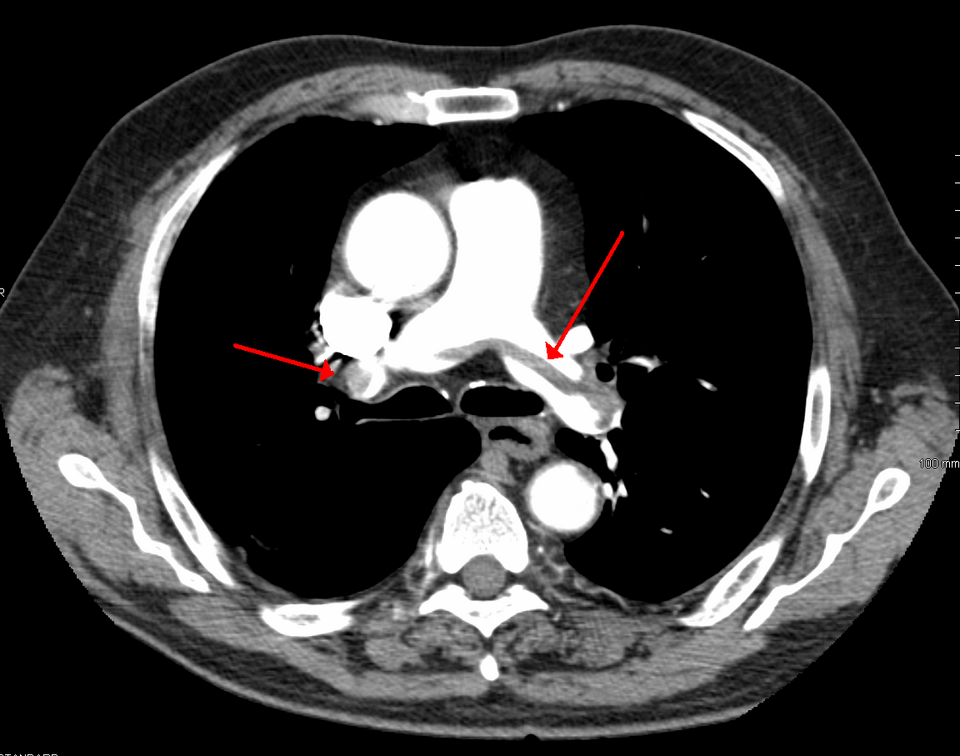 SaddlePE CT pulmonary angiography showing large saddle pulmonary embolism at the bifurcation.