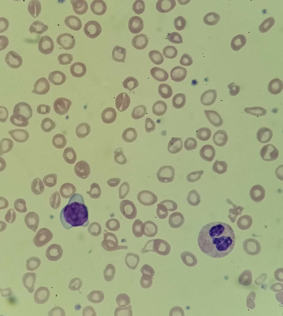 Severe_iron_deficiency_anemia Blood smear demonstrating hypochromic red cells with increased central pallor in microcytic anemia.
