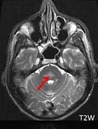 ods T2 MRI showing hyperintense lesion in pons due to osmotic demyelination.